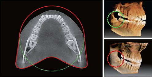 CBCT Extended Arch