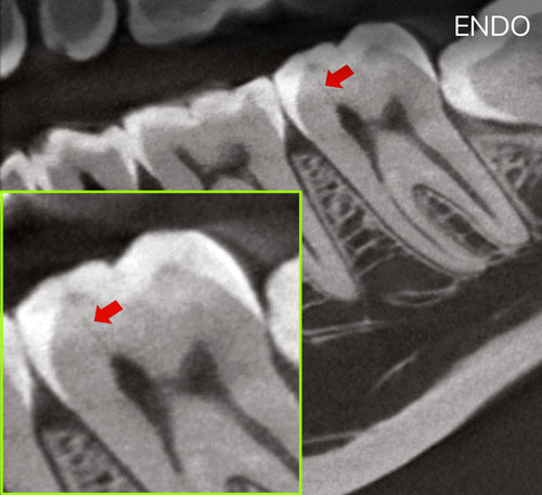 dental-vs-endo-2b